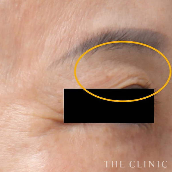 目の上のくぼみのマイクロCRF注入(顔の脂肪注入)（61歳女性）の術前写真