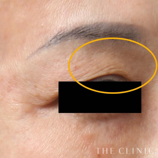 目の上のくぼみのマイクロCRF注入(顔の脂肪注入)（61歳女性）の術後写真