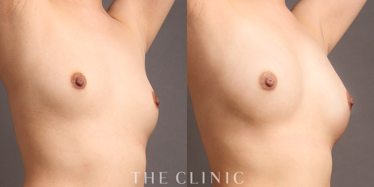 コンデンスリッチ豊胸の術前/術後