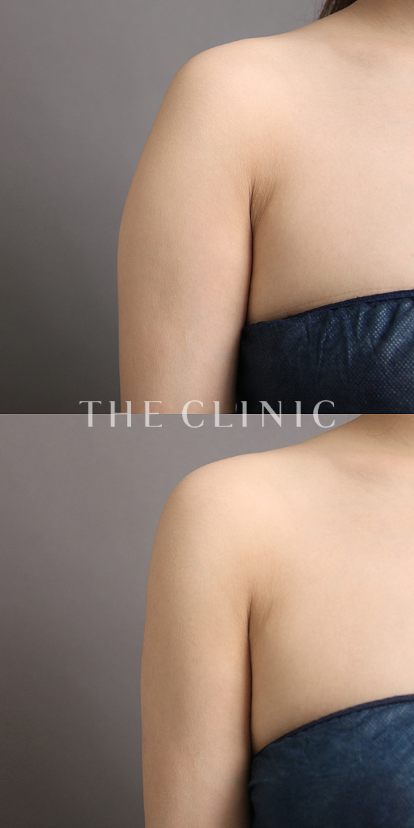 二の腕の二の腕症例（32歳女性）の術前・術後写真