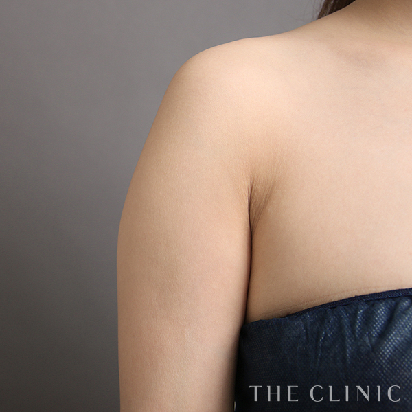 二の腕の二の腕症例（32歳女性）の術前写真