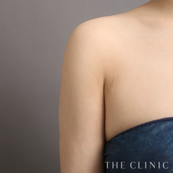 二の腕の二の腕症例（32歳女性）の術後写真