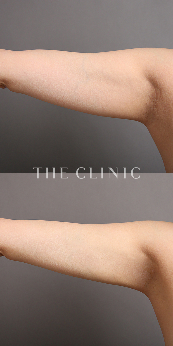 二の腕のベイザー脂肪吸引（32歳女性）の術前・術後写真