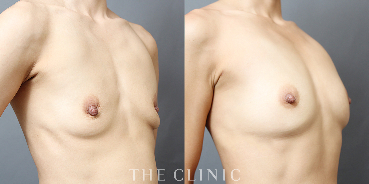 コンデンスリッチ豊胸の術前/術後