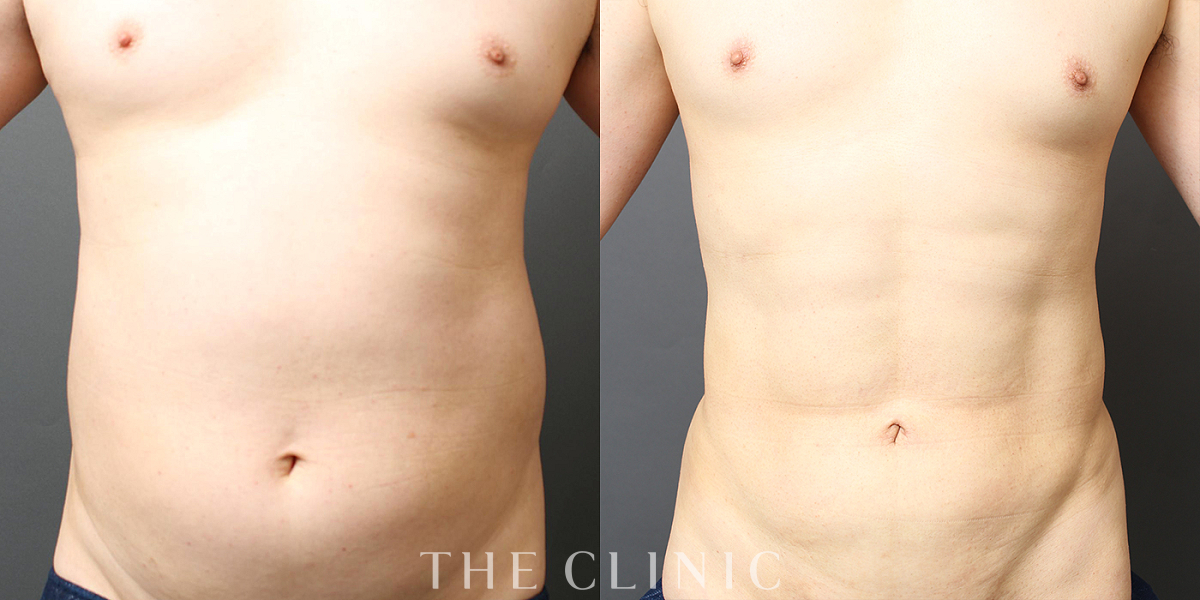 ベイザー4D(男性のシックスパック脂肪吸引)の術前／術後