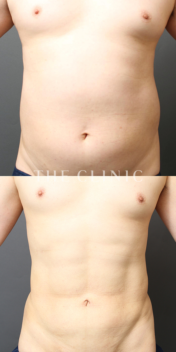 腹部・腰・ウエスト・SIX PACK ６つに割れた腹筋のベイザー4D(男性のシックスパック脂肪吸引)（35歳男性）の術前・術後写真