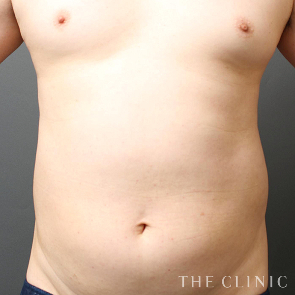 腹部・腰・ウエスト・SIX PACK ６つに割れた腹筋のベイザー4D(男性のシックスパック脂肪吸引)（35歳男性）の術前写真
