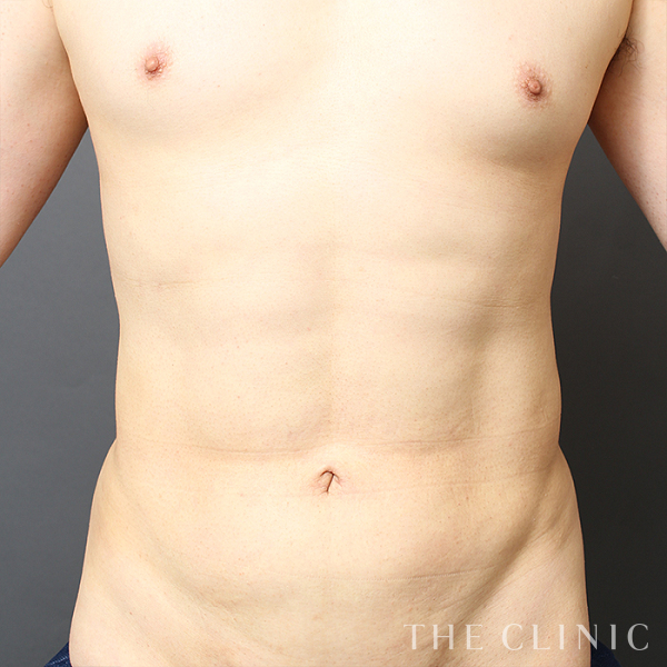 腹部・腰・ウエスト・SIX PACK ６つに割れた腹筋のベイザー4D(男性のシックスパック脂肪吸引)（35歳男性）の術後写真
