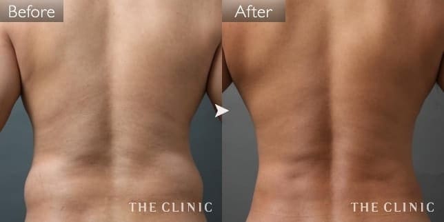 腰・ウエストのメンズ脂肪吸引／40代男性