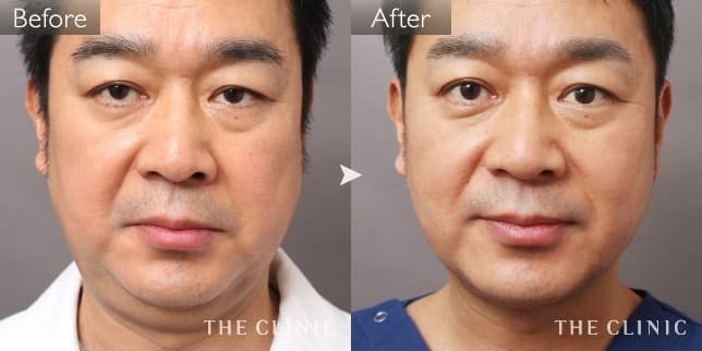 顔（頰・顎）のメンズ脂肪吸引／40代男性