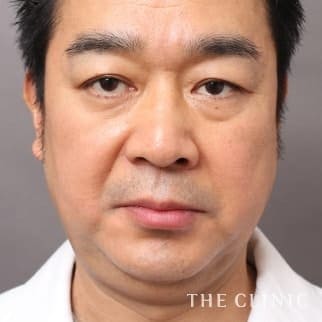 頰／顎のベイザー脂肪吸引のモニター（40代）術前症例画像