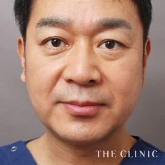 頰／顎のベイザー脂肪吸引のモニター（40代）術後症例画像