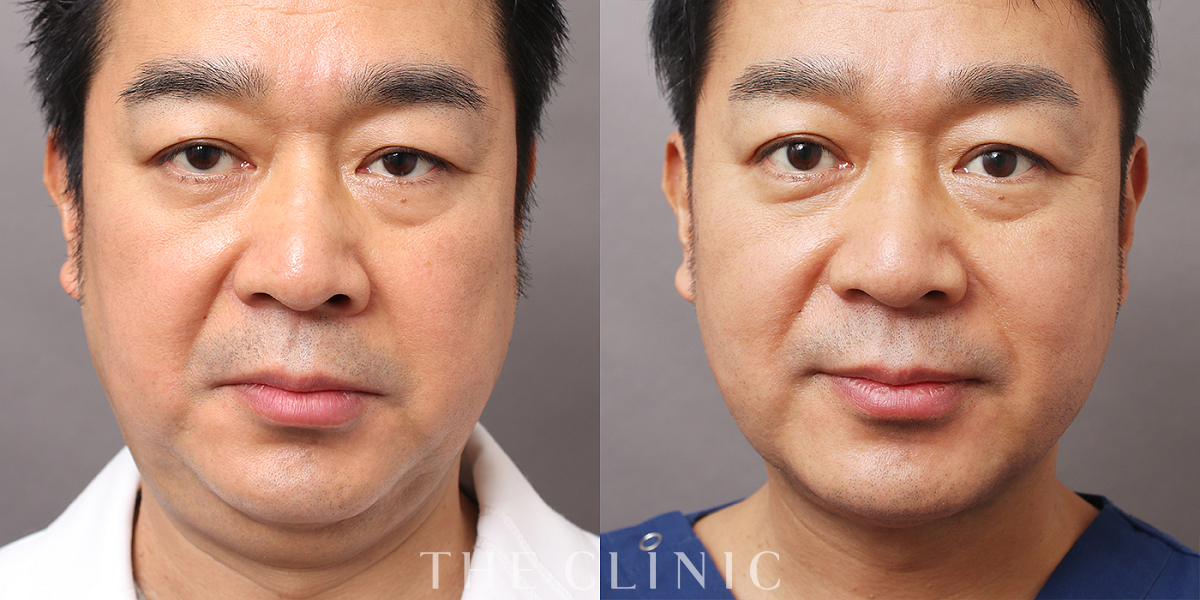 360脂肪吸引®の術前／術後