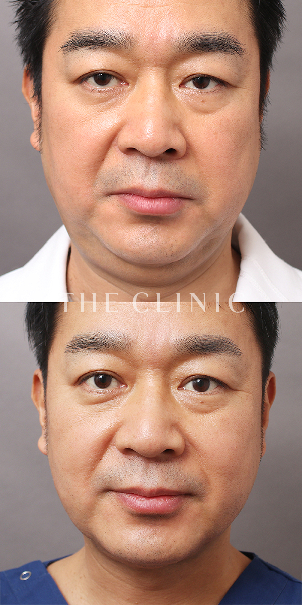頰／顎の360脂肪吸引®（48歳男性）の術前・術後写真