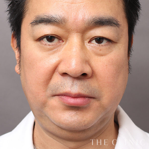 頰／顎の360脂肪吸引®（48歳男性）の術前写真