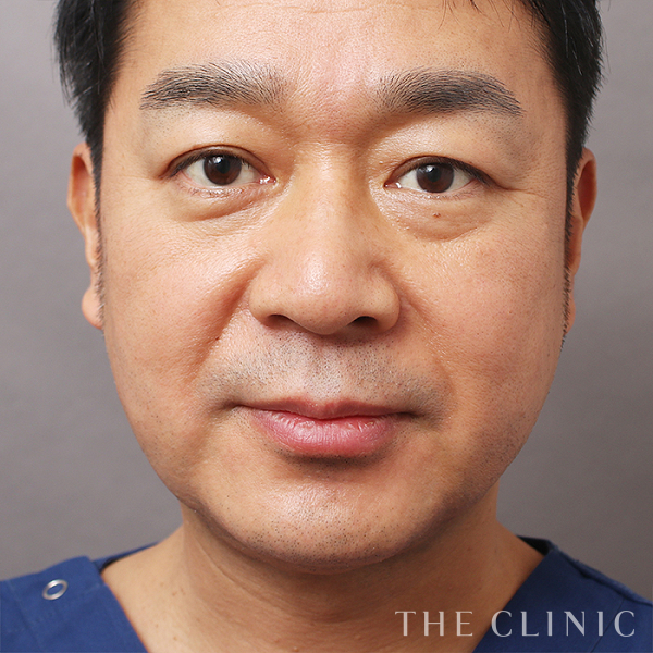 頰／顎の360脂肪吸引®（48歳男性）の術後写真