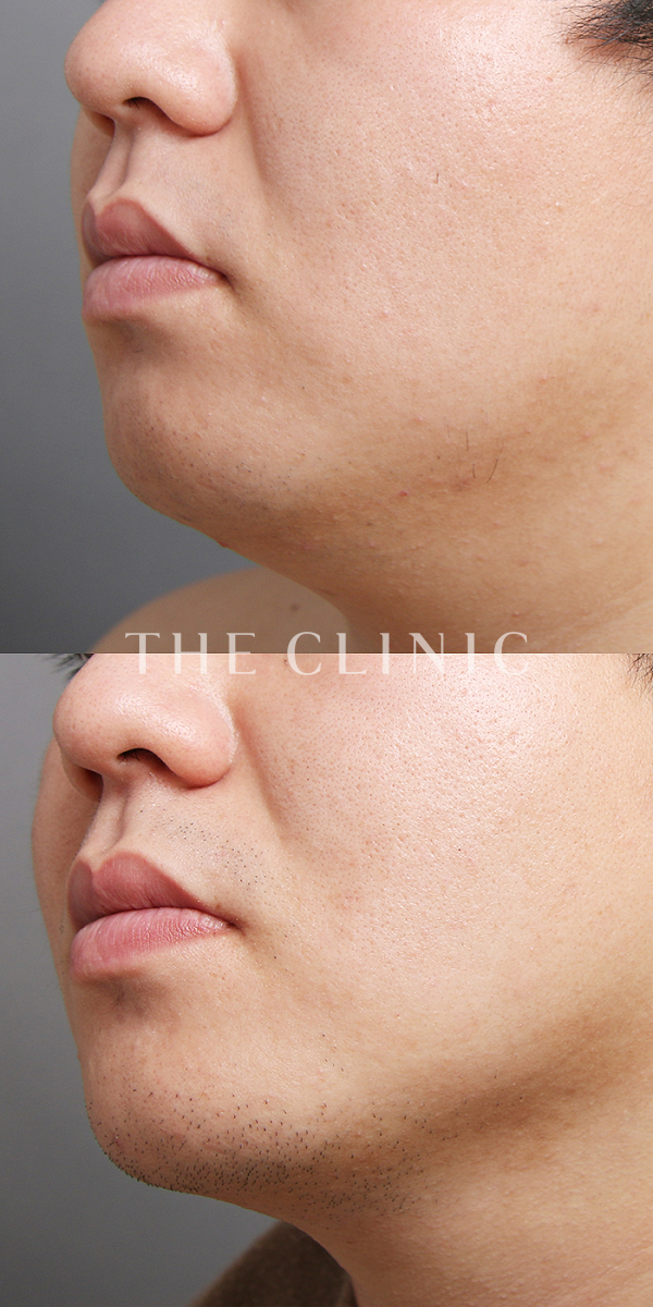 頰／顎のベイザー脂肪吸引（28歳男性）の術前・術後写真