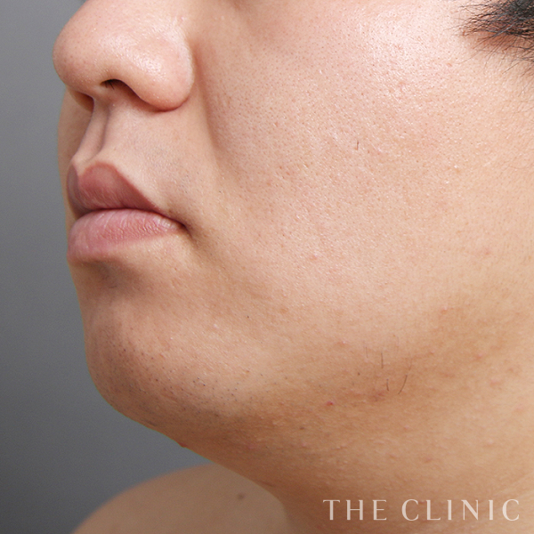 頰／顎のベイザー脂肪吸引（28歳男性）の術前写真