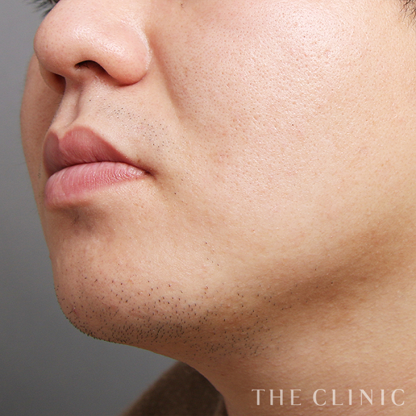 頰／顎のベイザー脂肪吸引（28歳男性）の術後写真