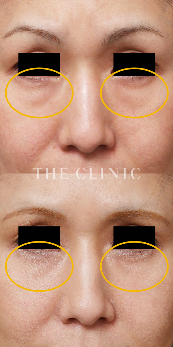 目の下のクマ・目の下のたるみのマイクロCRF注入(顔の脂肪注入)（44歳女性）の術前・術後写真