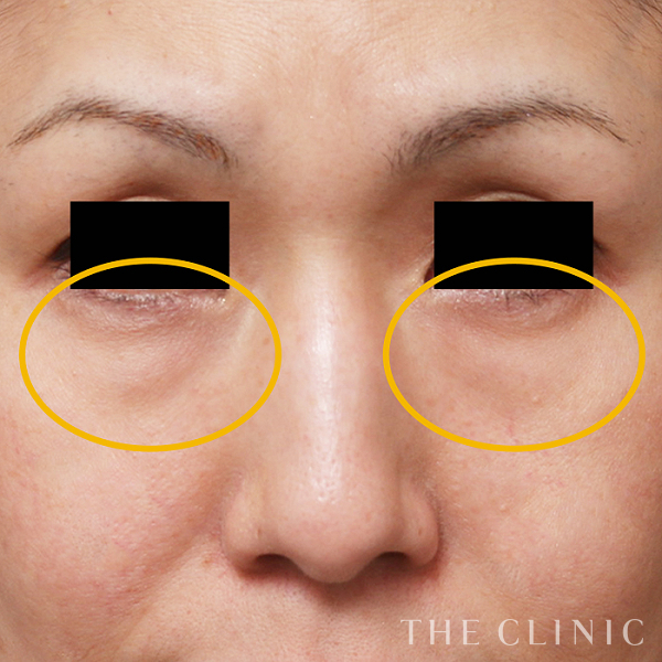 目の下のクマ・目の下のたるみのマイクロCRF注入(顔の脂肪注入)（44歳女性）の術前写真