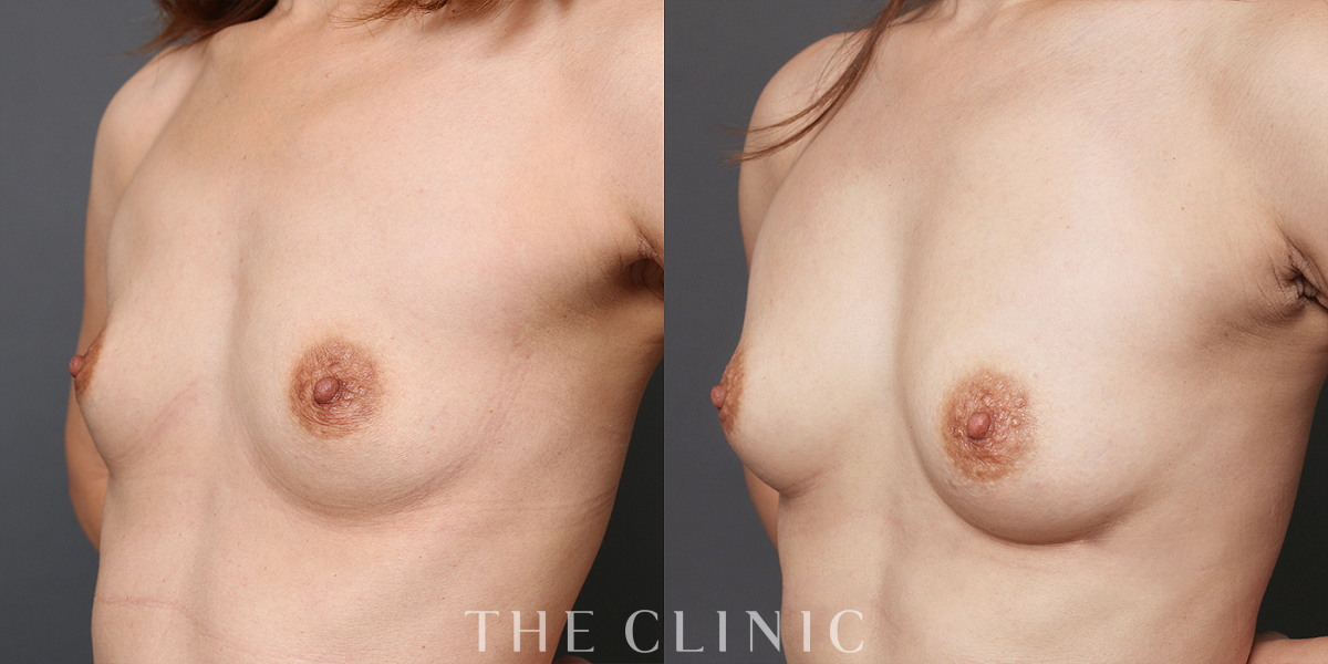 コンデンスリッチ豊胸の術前/術後