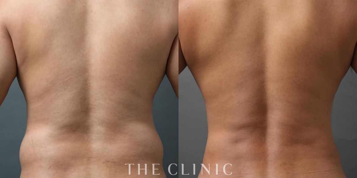 ベイザー4D(男性のシックスパック脂肪吸引)の術前/術後