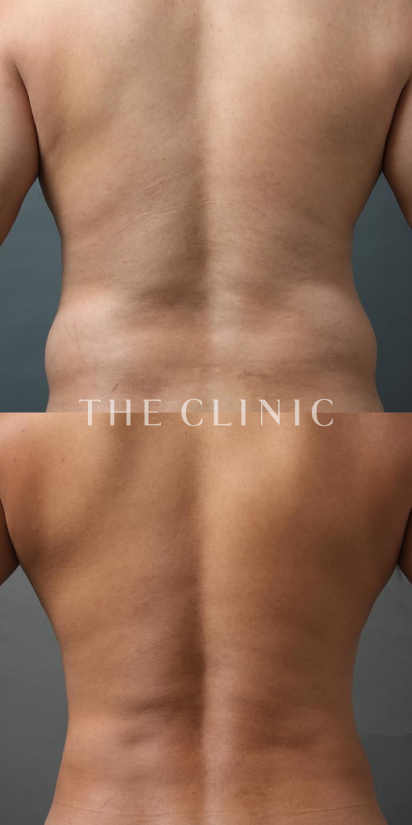 腹部のベイザー4D(男性のシックスパック脂肪吸引)（42歳男性）の術前・術後写真