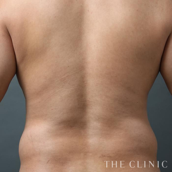 腹部のベイザー4D(男性のシックスパック脂肪吸引)（42歳男性）の術前写真