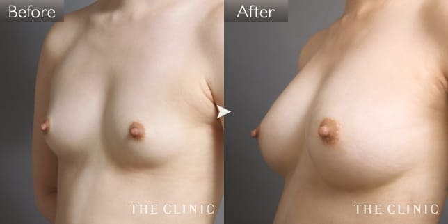 ボリュームアップ(女性/28歳)