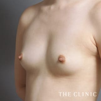 【THE CLINIC 症例画像】No.754_1_ボリュームアップ_コンデンスリッチ豊胸