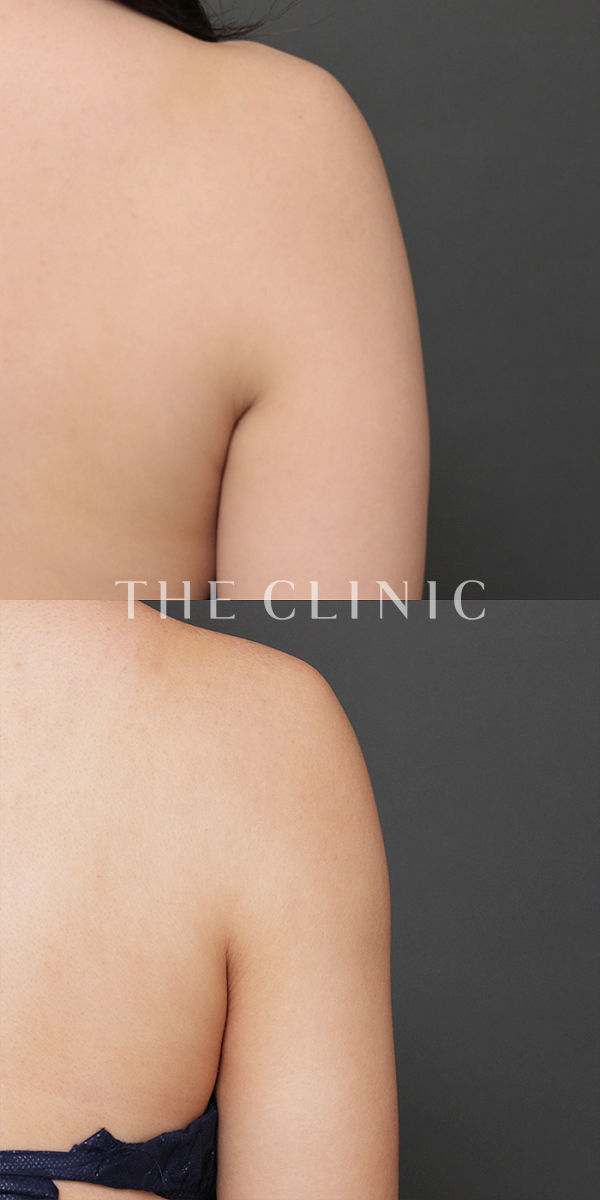 二の腕のベイザー脂肪吸引（28歳女性）の術前・術後写真