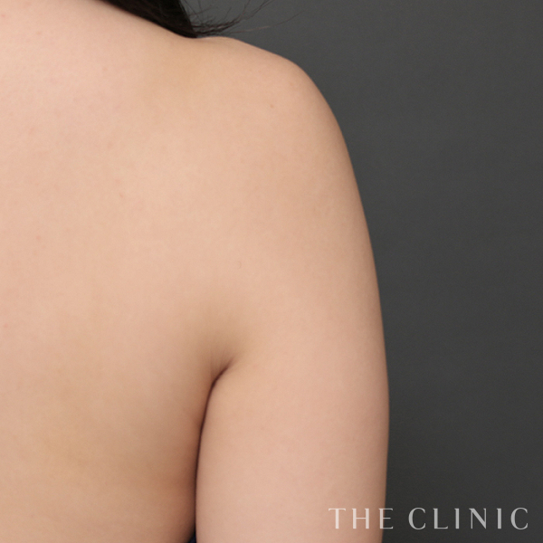 二の腕のベイザー脂肪吸引（28歳女性）の術前写真