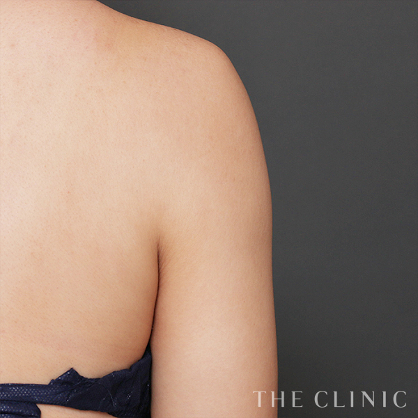 二の腕のベイザー脂肪吸引（28歳女性）の術後写真