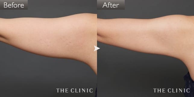 二の腕 症例写真