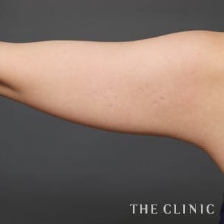 【THE CLINIC 症例画像】No.758_1_二の腕_360脂肪吸引®