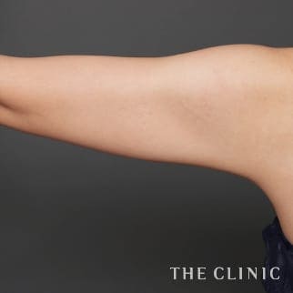 【THE CLINIC 症例画像】No.758_2_二の腕_360脂肪吸引®