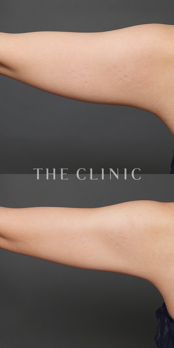 二の腕のベイザー脂肪吸引（28歳女性）の術前・術後写真