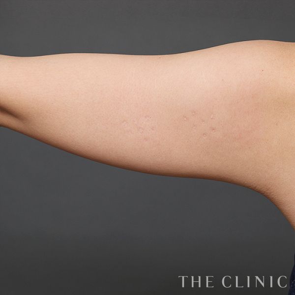 二の腕のベイザー脂肪吸引（28歳女性）の術前写真