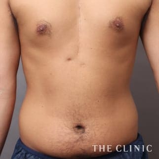 胸部のデザイン／SIX PACK ６つに割れた腹筋のベイザー4D(男性のシックスパック脂肪吸引)のモニター（20代）術前症例画像