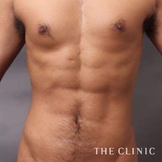 胸部のデザイン／SIX PACK ６つに割れた腹筋のベイザー4D(男性のシックスパック脂肪吸引)のモニター（20代）術後症例画像