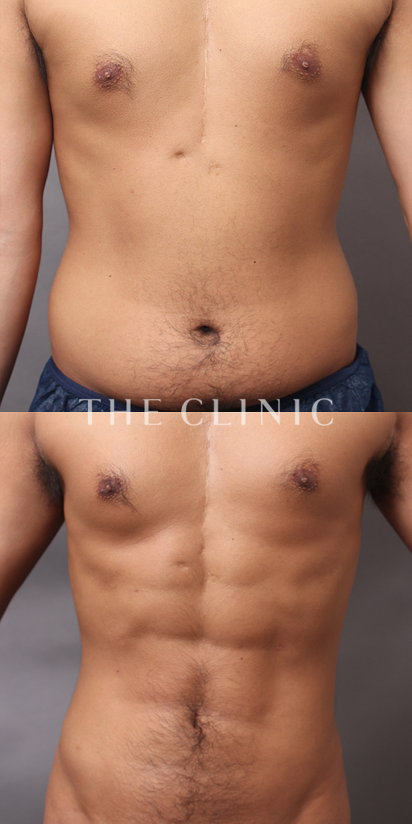 胸部のデザイン・SIX PACK ６つに割れた腹筋のベイザー4D(男性のシックスパック脂肪吸引)（28歳男性）の術前・術後写真
