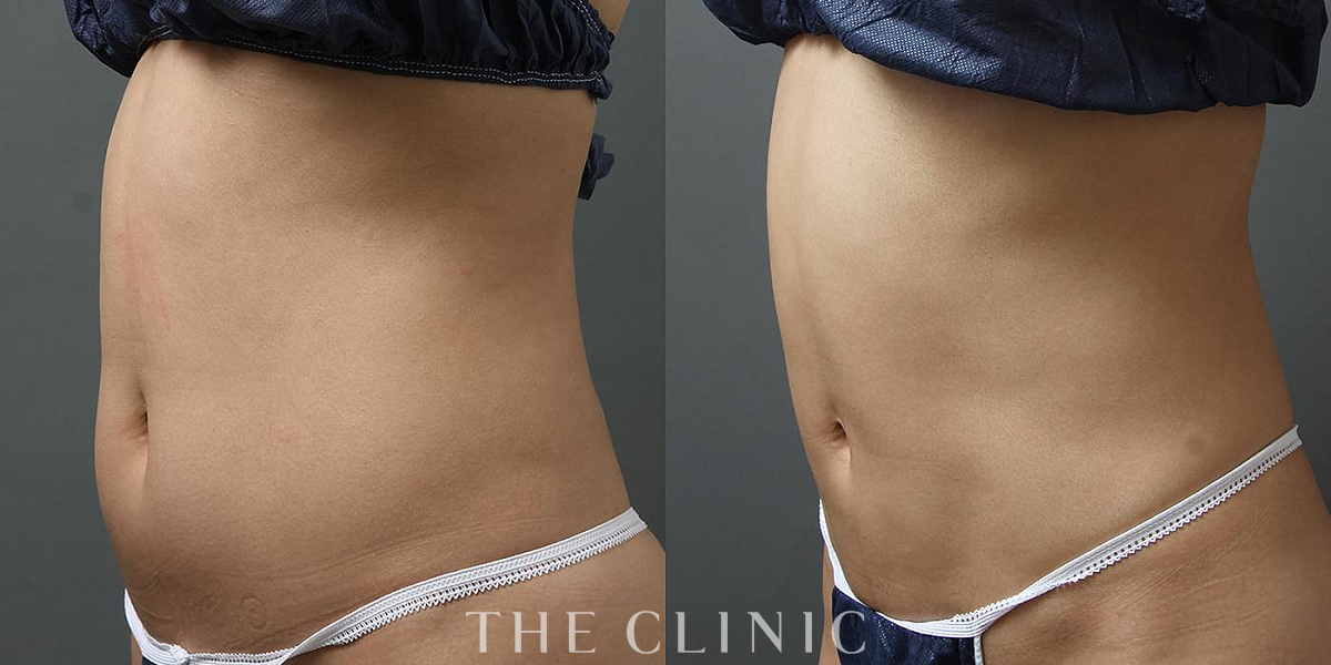 360脂肪吸引®の術前／術後