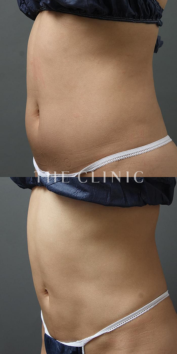 腹部の360脂肪吸引®（36歳女性）の術前・術後写真