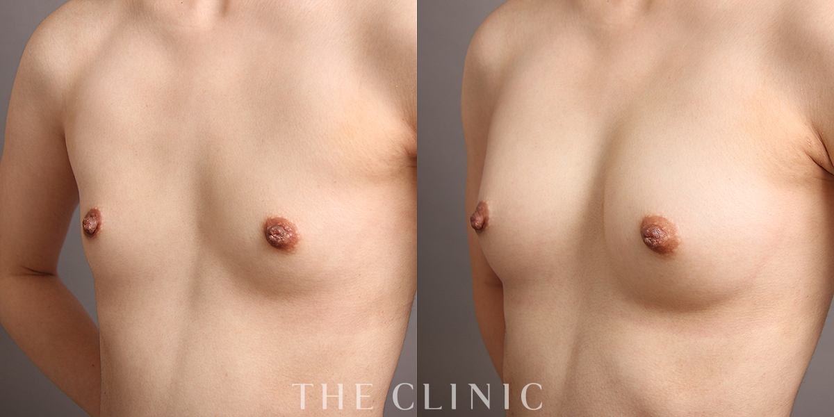 コンデンスリッチ豊胸の術前/術後