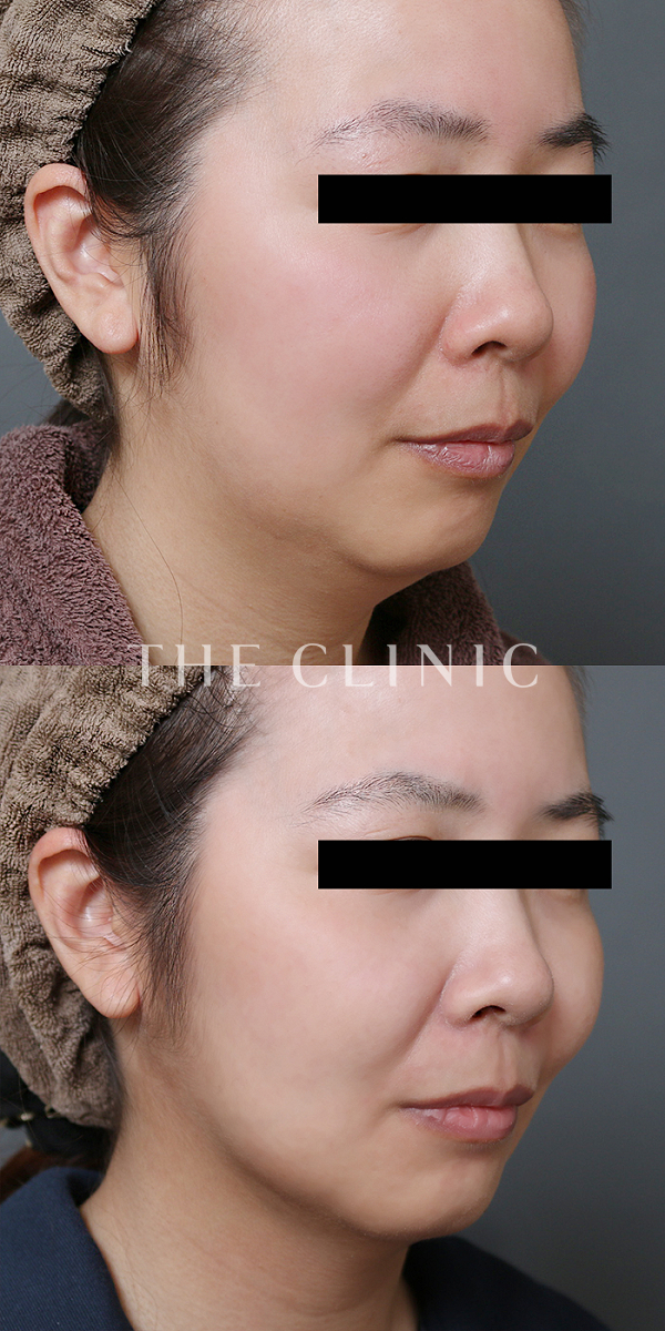 頰／顎のベイザー脂肪吸引（36歳女性）の術前・術後写真