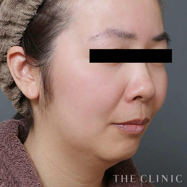 頰／顎のベイザー脂肪吸引（36歳女性）の術前写真