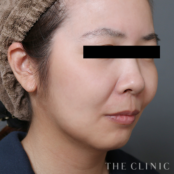 頰／顎のベイザー脂肪吸引（36歳女性）の術後写真