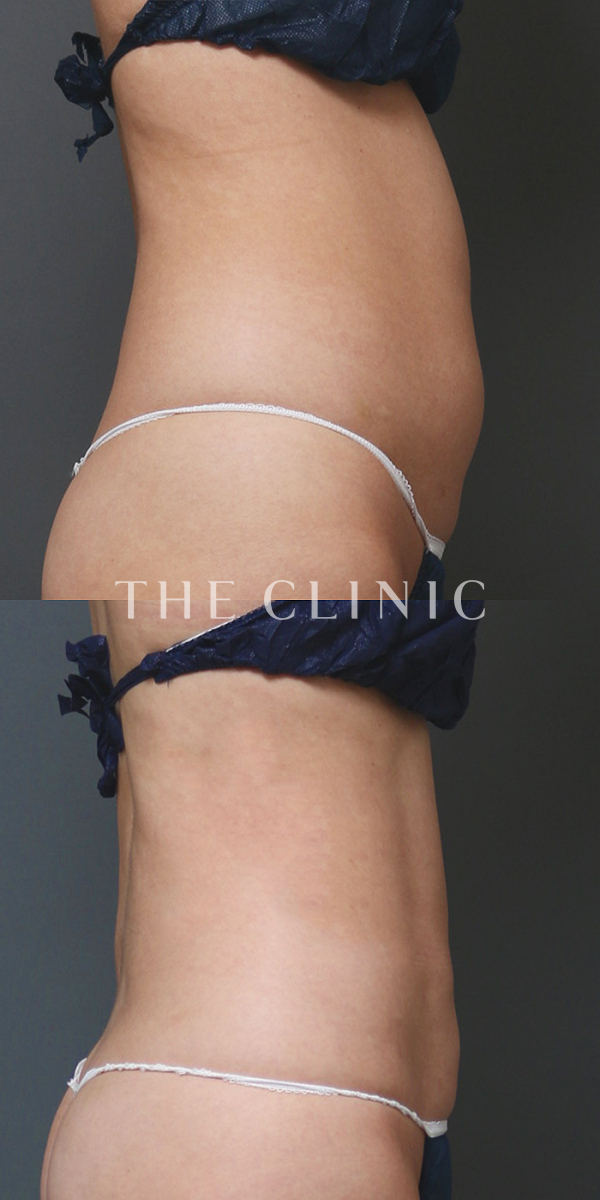 腹部・腰・ウエストのベイザー脂肪吸引（36歳女性）の術前・術後写真
