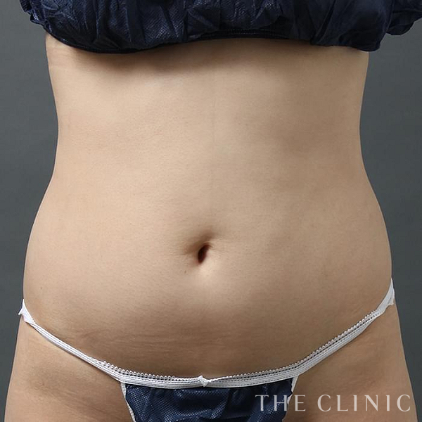 腹部のベイザー脂肪吸引（29歳女性）の術前写真